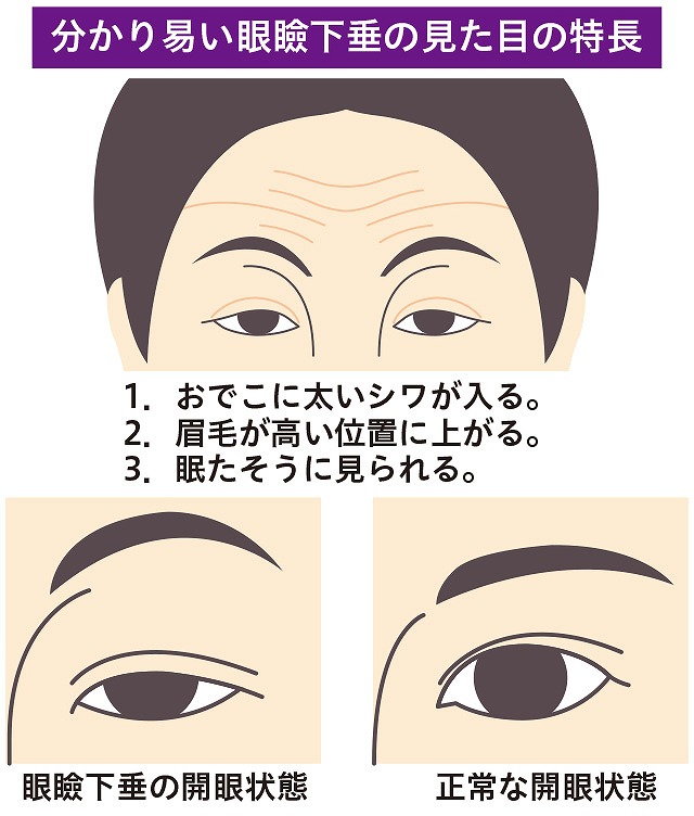 眼瞼下垂とは